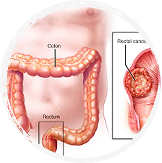 Colon Cancer